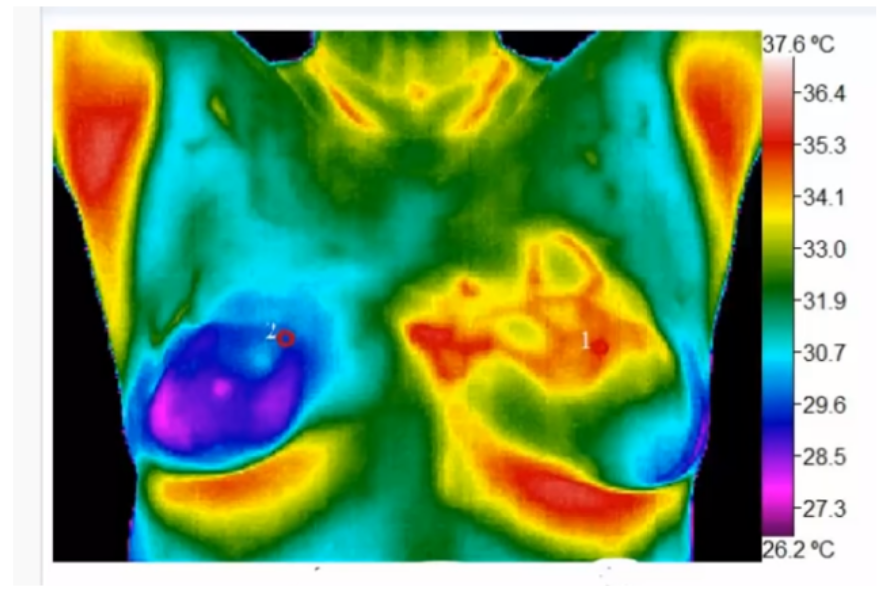 breast_thermography_image