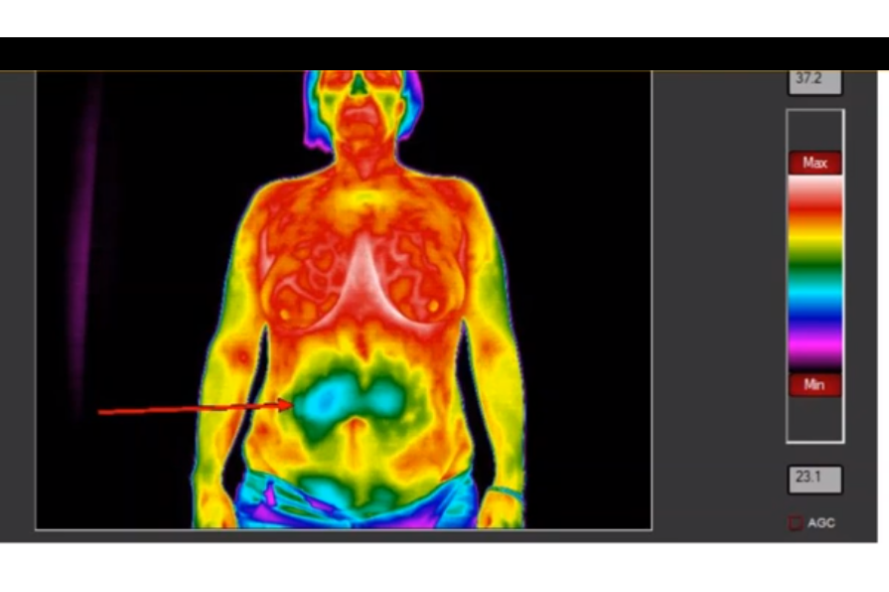 thoracic_thermography_image